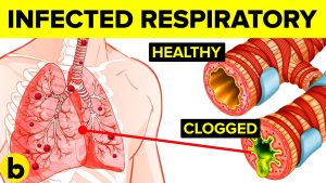 The image shows the steps to prevent the spread of respiratory infections. The healthy lungs are on the left, and the infected lungs are on the right. The red circle shows where the infection starts, and the green circle shows where the infection can spread to. The image also shows how the infection can clog the airways, making it difficult to breathe.