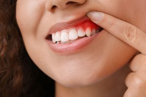 A close-up of a person's mouth showing healthy teeth and gums.