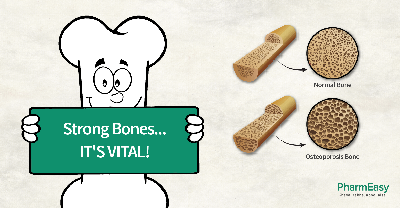 A cartoon character holding a sign that says "Strong bones...It's Vital!" next to a normal bone and an osteoporosis bone.